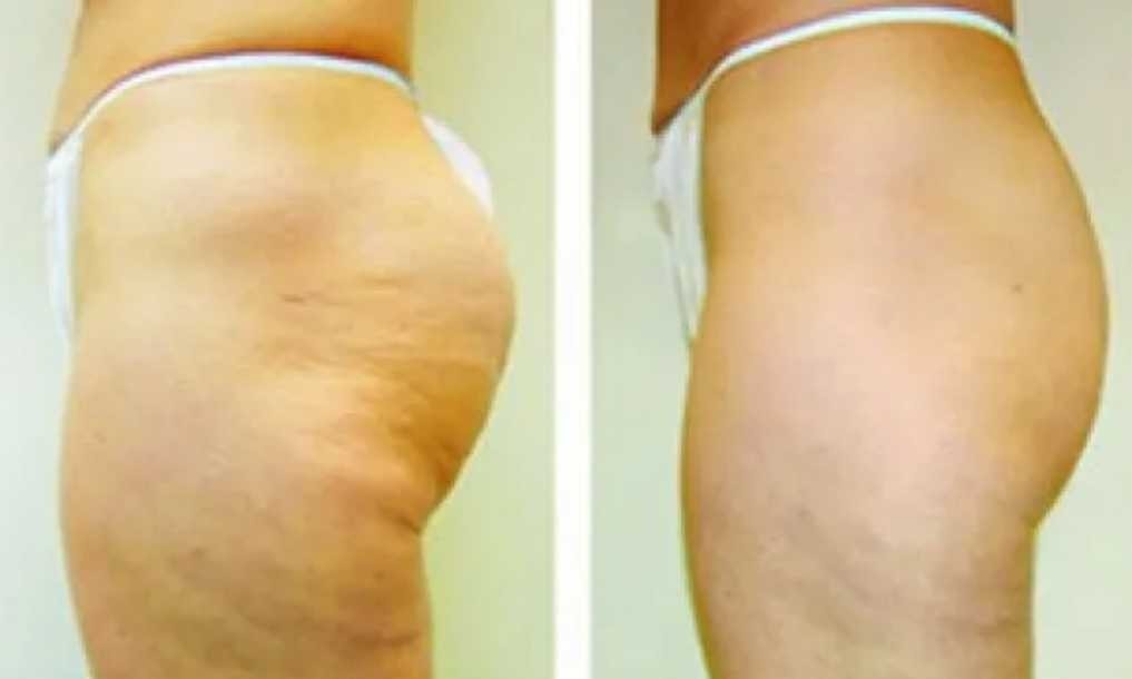 Signature #tuzla Tretmani tijela Kavitacija - po regiji