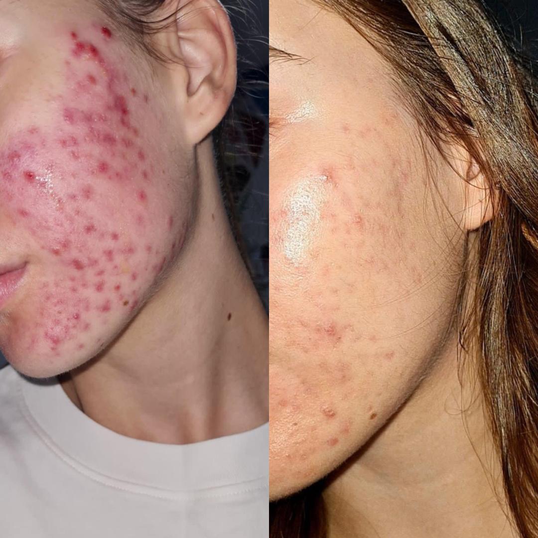 Hemijski piling - akne - Hanas Skin Centar, Banja Luka Tretman lica Lice Tretman lica, Banja Luka, Centar