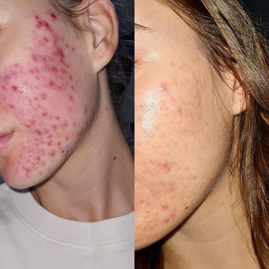 Hanas Skin Centar #banjaluka Tretman lica Hemijski piling - akne