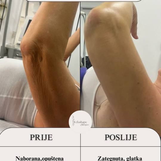 VelaShape #sarajevo Radiofrekvencija zona ruke