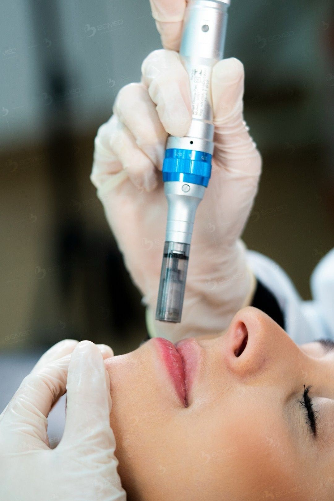 Soft Touch Beauty Studio #sarajevo Tretman lica Microneedling