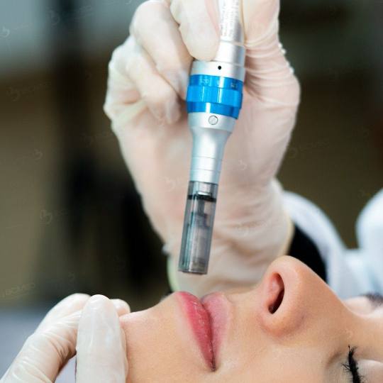 Soft Touch Beauty Studio #sarajevo Tretman lica Microneedling Microneedling je efikasan tretman koji