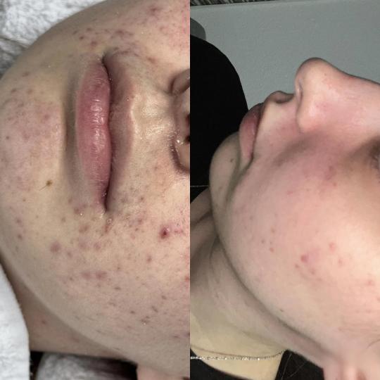 Hanas Skin Centar #banjaluka Tretman lica Hemijski piling - akne