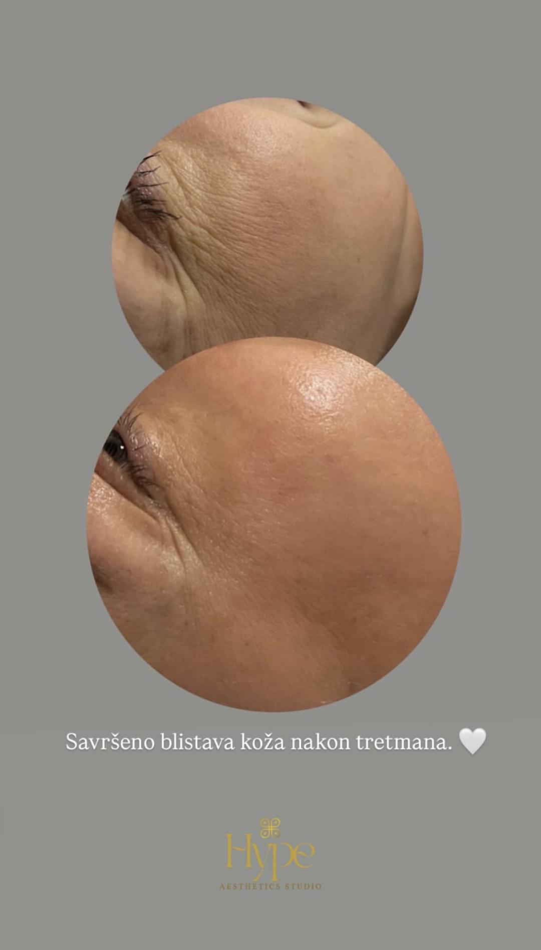 Hydrafacial Complete Skin tretman lica - Hype Aesthetics Studio, Sarajevo Svjetlosna terapija lica Lice Svjetlosna terapija lica, Sarajevo, Novo Sarajevo - Novi Grad