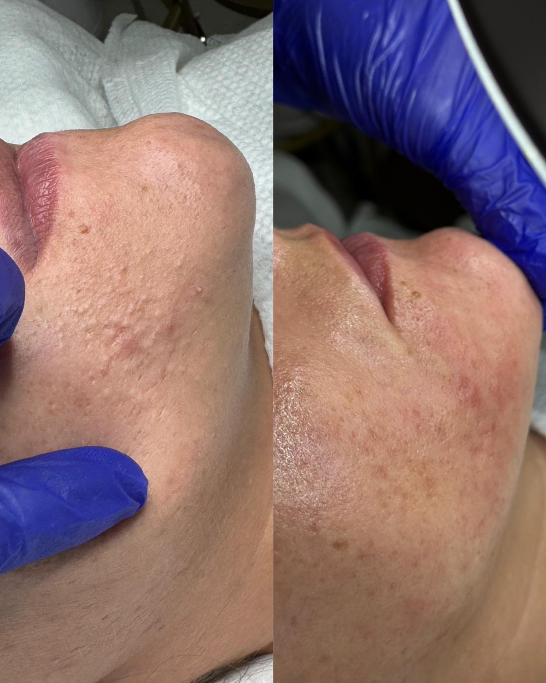 Hanas Skin Centar #banjaluka Air brush potamnjivanje kože Klasično higijensko čišćenje lica