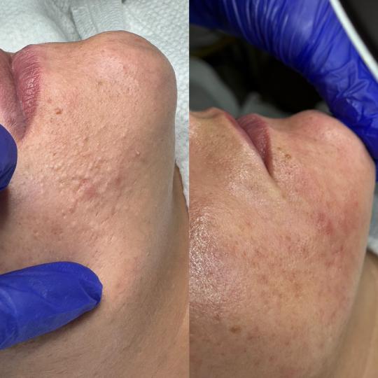 Hanas Skin Centar #banjaluka Air brush potamnjivanje kože Klasično higijensko čišćenje lica Pro