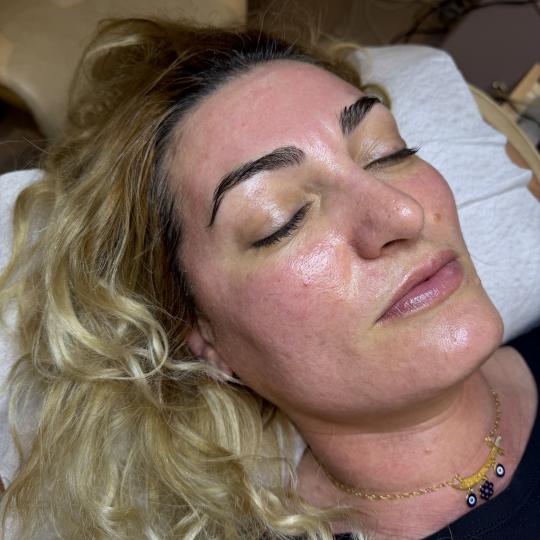 Deiva Allure #sarajevo Tretman lica Microneedling lifting lica - Egf Tight