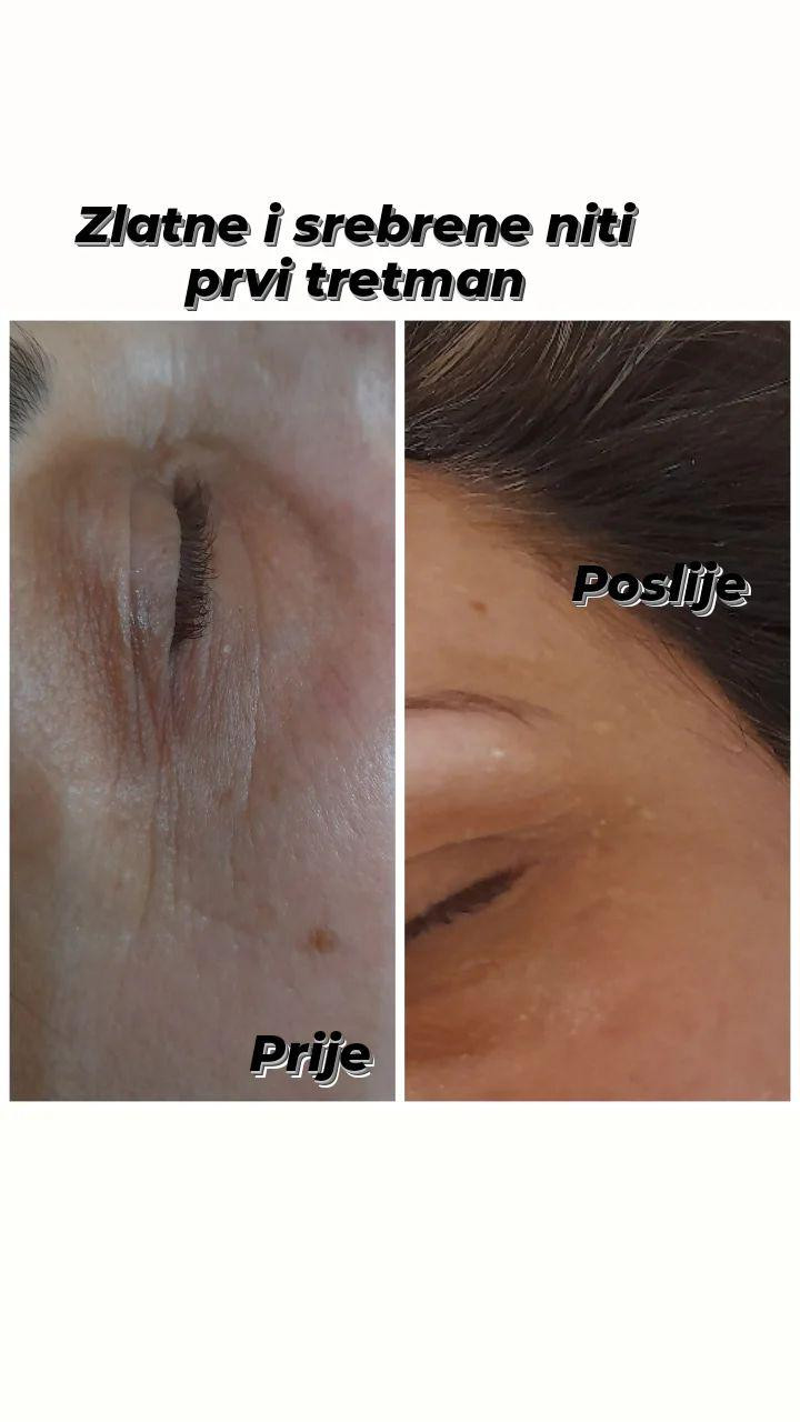Tretman srebrnim + zlatnim nitima - lice + vrat + dekolte - Poezija ljepote, Sarajevo Tretman lica Lice Tretman lica, Sarajevo, Novo Sarajevo - Novi Grad