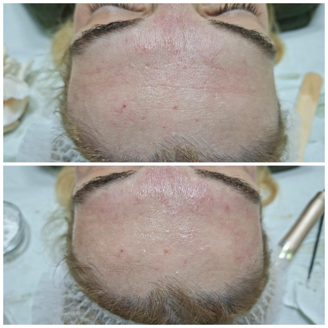 Botox box tretman lica - La Piel, Mostar Tretman lica Lice Tretman lica, Mostar, Centar