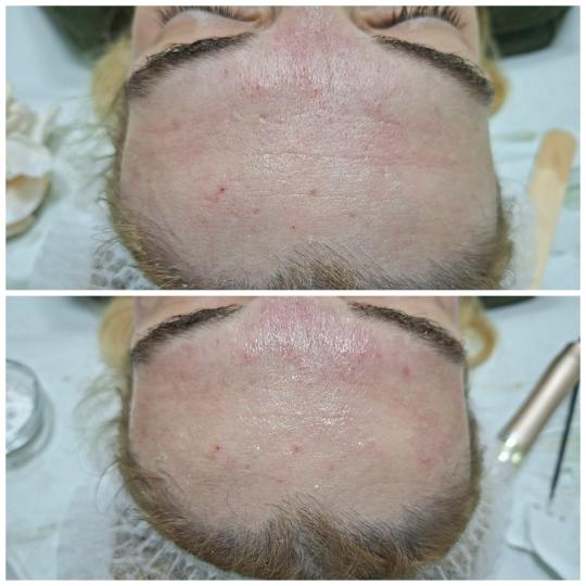 La Piel #mostar Tretman lica Botox box tretman lica