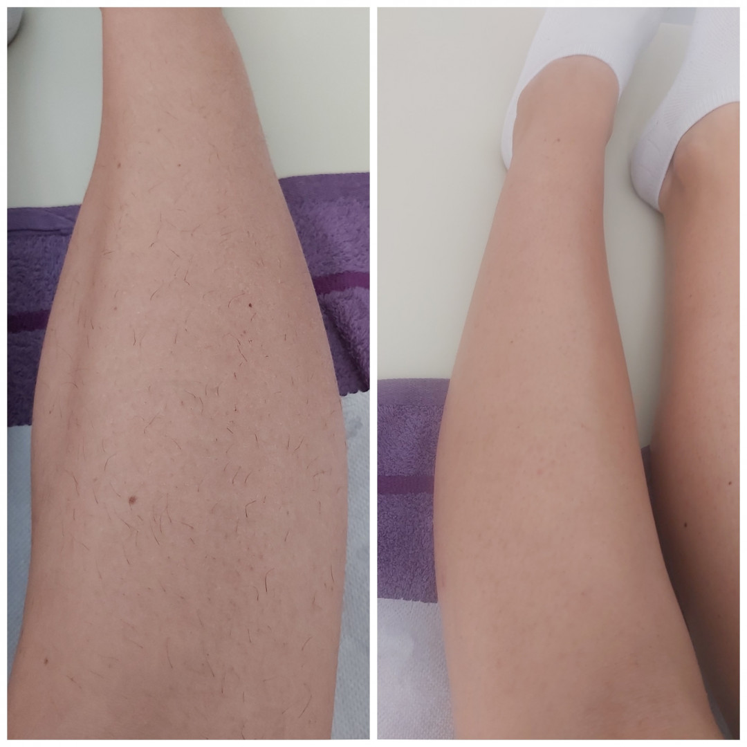 Relax Studio Hodžić #sarajevo Depilacija voskom Depilacija pola nogu Lycon voskom - za dame i muškarce