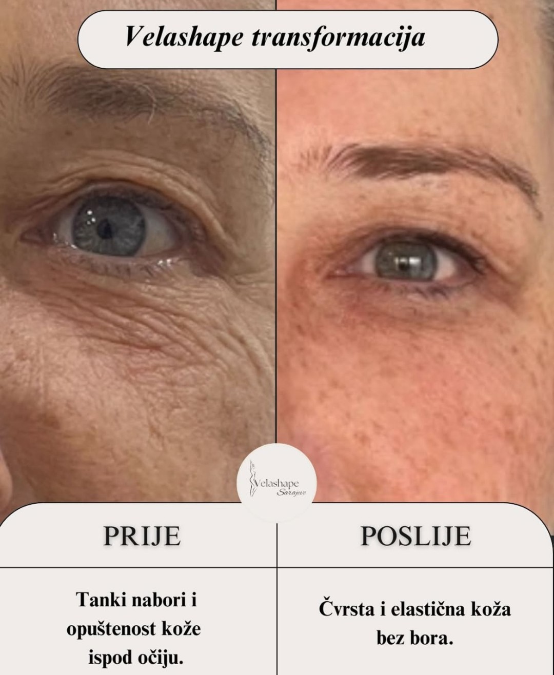 VelaShape #sarajevo Tretman lica RF tretman - lice + vrata