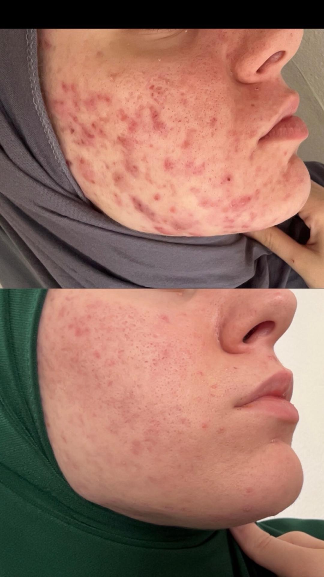 Damen #sarajevo Tretman lica Ultrazvučno čišćenje + microneedling tretman lica