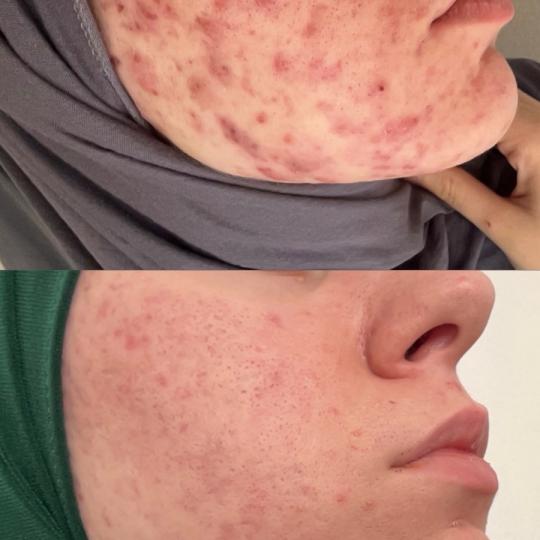 Damen #sarajevo Tretman lica Ultrazvučno čišćenje + microneedling tretman lica Liječenje akni m