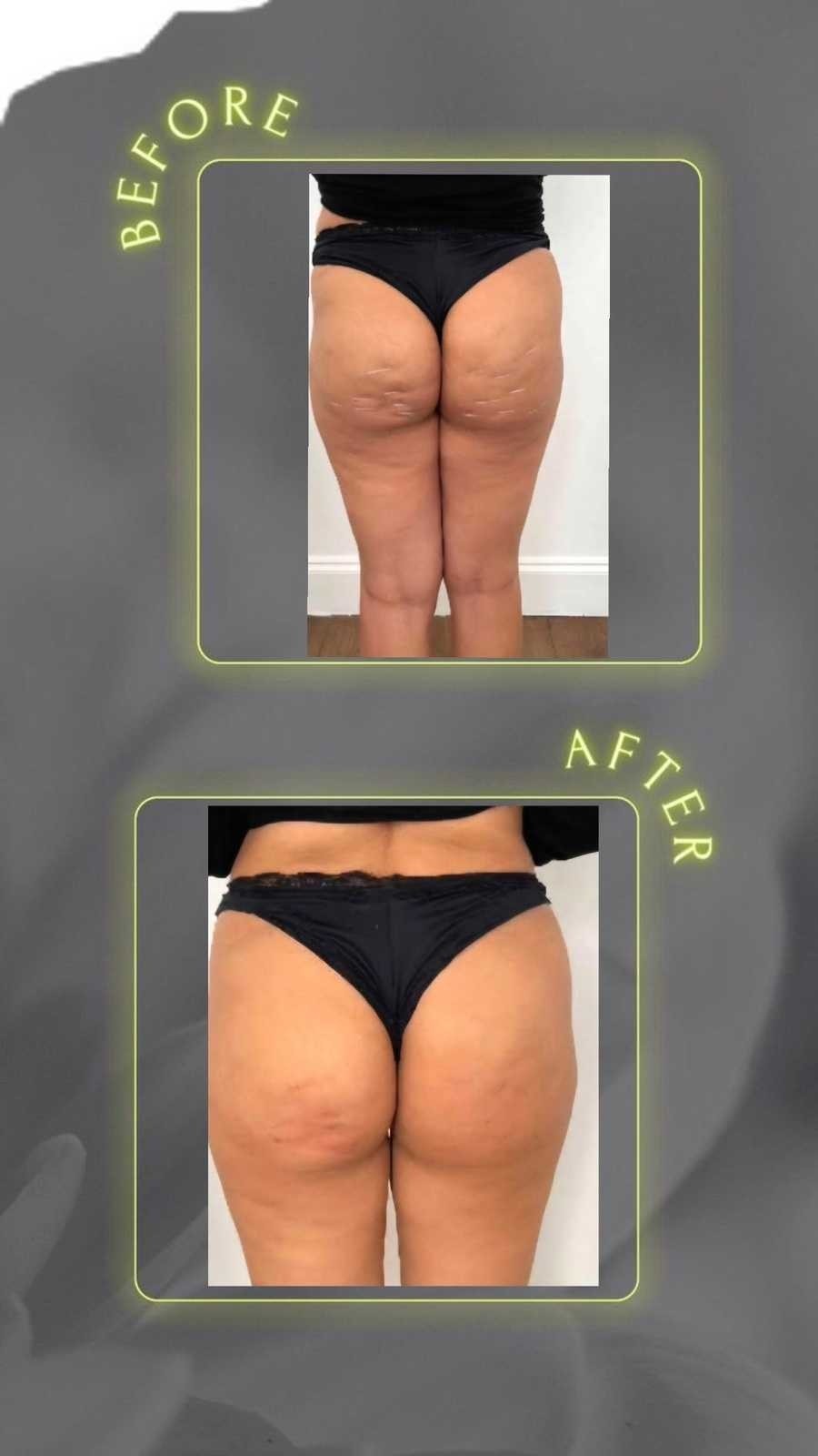 Signature #tuzla Tretmani tijela Lipoliza 10 ml