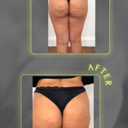 Signature #tuzla Tretmani tijela Lipoliza 10 ml uklanjanje masnih naslaga