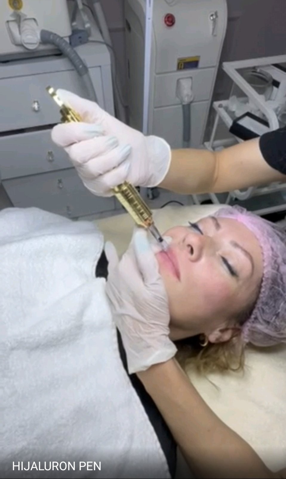 Stefy Star #banjaluka Hijaluronski tretmani lica Hijaluron pen - usne