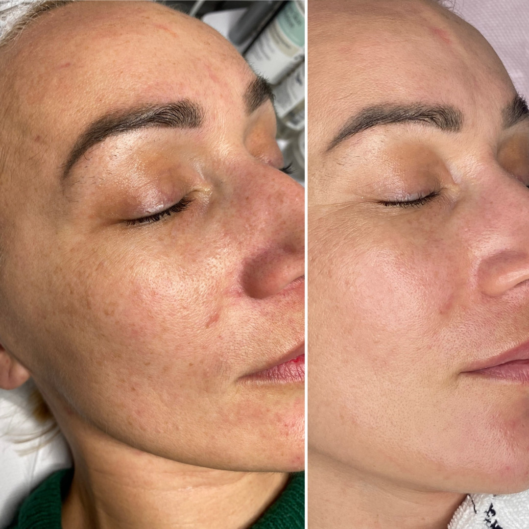 Paket tretmana za pigmentacijske fleke - Fabrika ljepote, Sarajevo Tretmani tijela Tijelo Tretmani tijela, Sarajevo, Istočno Sarajevo