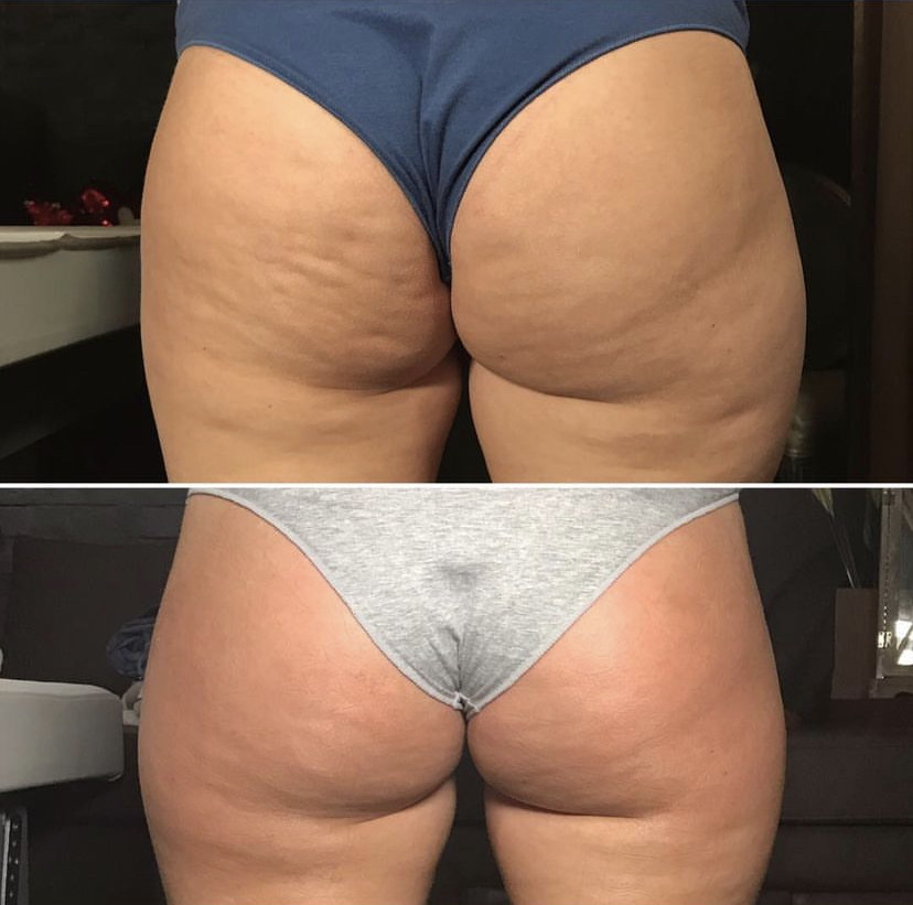 Skockica paket - maderoterapija cijelo tijelo - Fabrika ljepote, Sarajevo Anticelulit masaža Masaža Anticelulit masaža, Sarajevo, Istočno Sarajevo