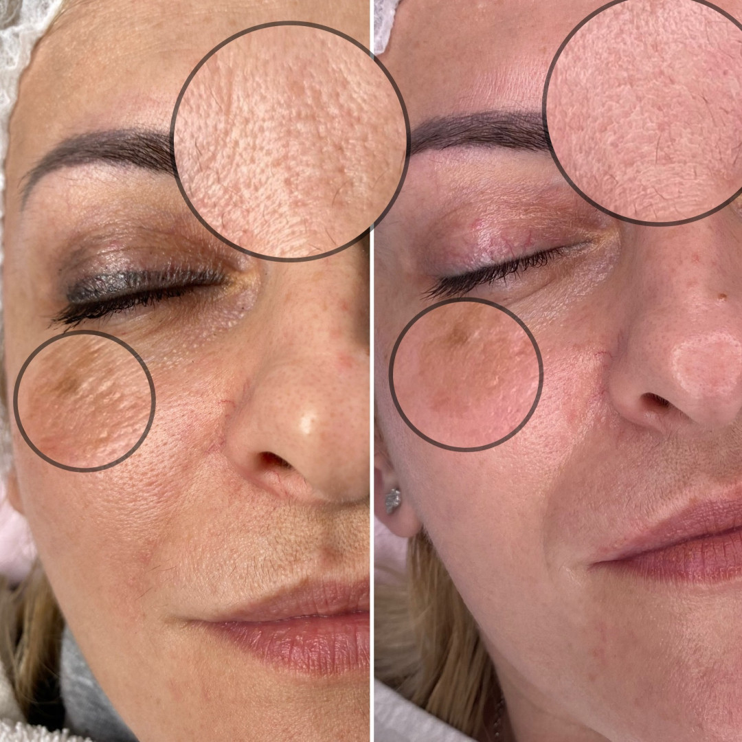 Paket tretmana za pigmentacijske fleke - Fabrika ljepote, Sarajevo Tretmani tijela Tijelo Tretmani tijela, Sarajevo, Istočno Sarajevo