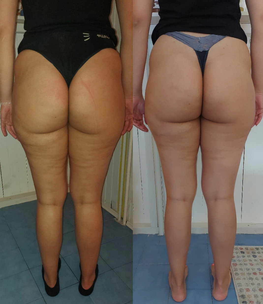 Nervus #banjaluka Anticelulit masaža Anticelulit masaža