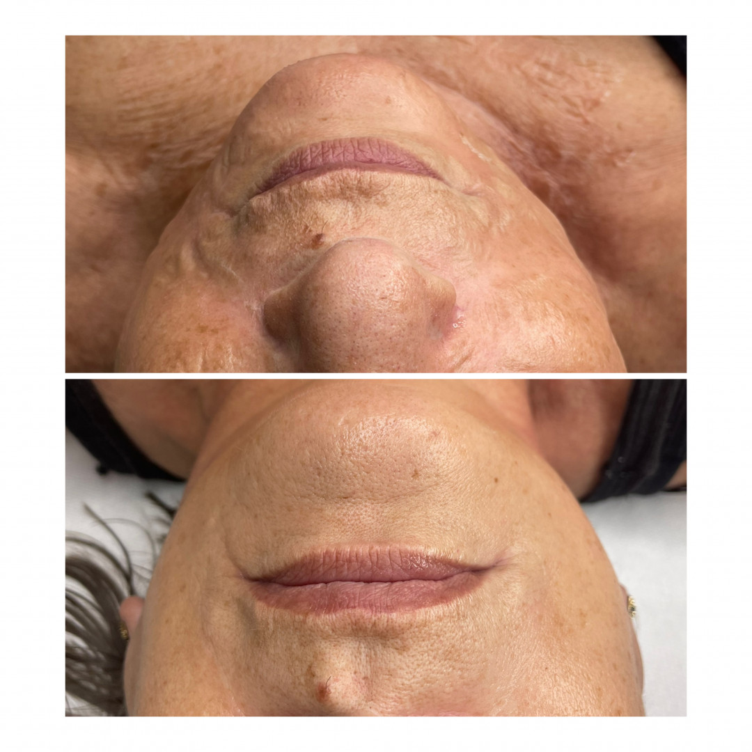 NO-TOX BOTOX - La Esthetique, Sarajevo Mezoterapija lica Lice Mezoterapija lica, Sarajevo, Novo Sarajevo - Novi Grad