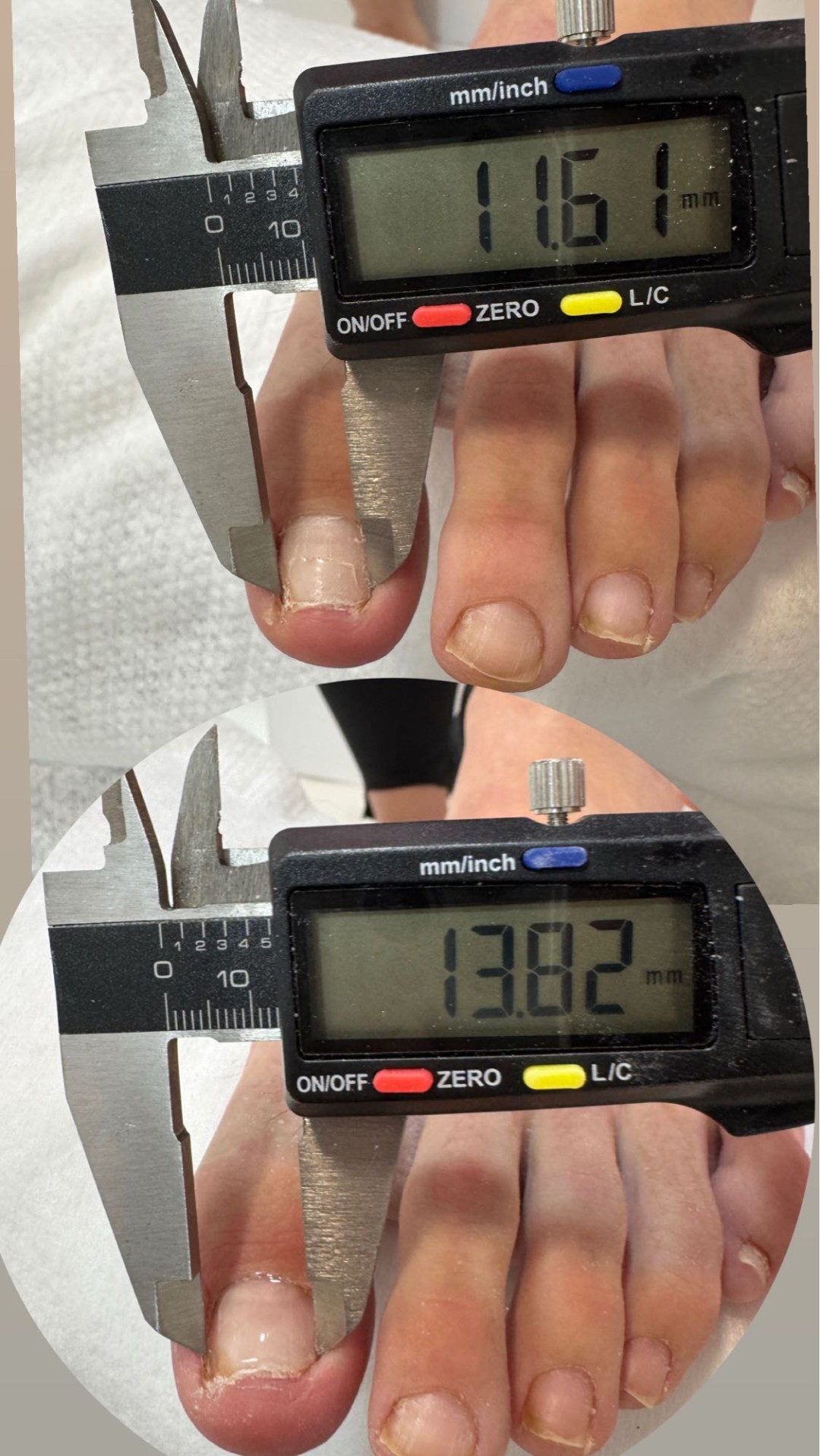 Fridem #banjaluka Medicinski pedikir Obrada uraslog nokta