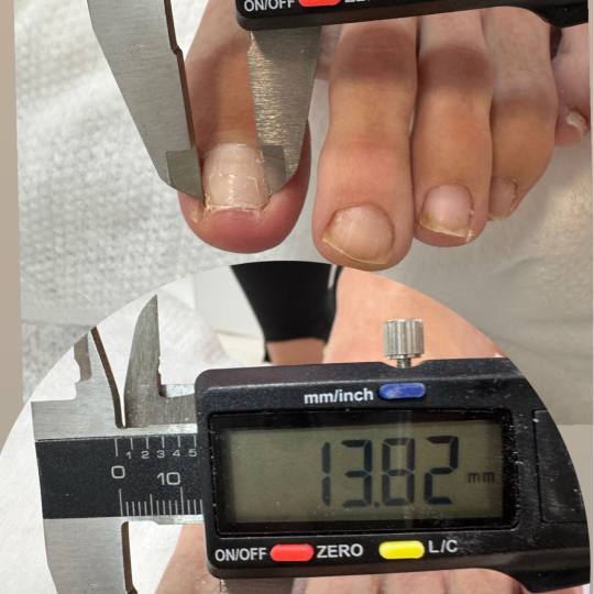 Fridem #banjaluka Medicinski pedikir Obrada uraslog nokta