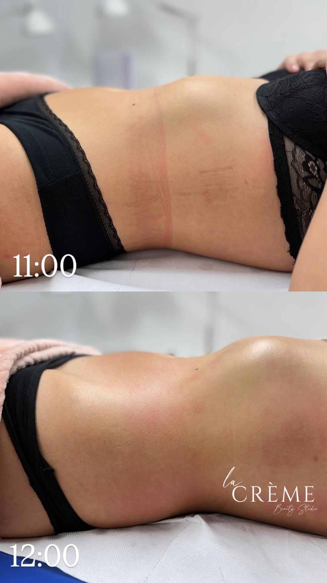 La Crème Beauty Studio #sarajevo Tretmani tijela Brazilska Limfna Drenaza - po regiji