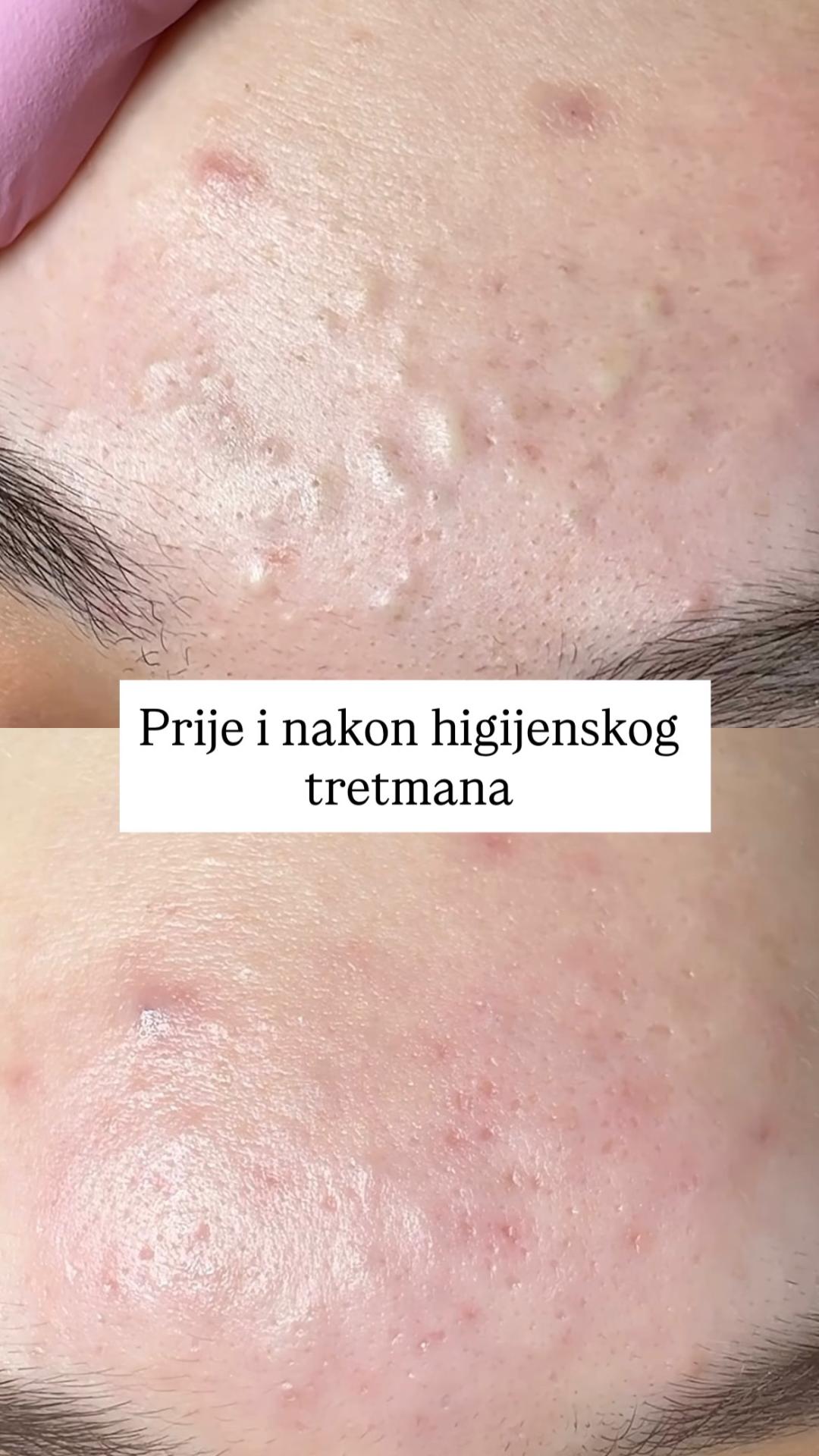 Higijenski tretman lica - komedoekspresija + ultrazvučno čišćenje - Damen, Sarajevo Tretman lica Lice Tretman lica, Sarajevo, Centar - Stari Grad