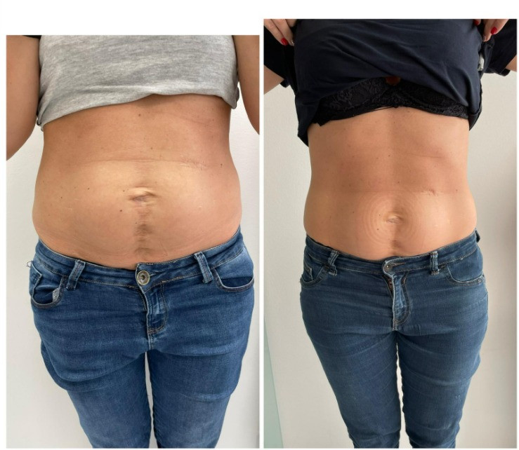 Sandra #visoko Tretmani tijela Kavitacija - natkoljenice