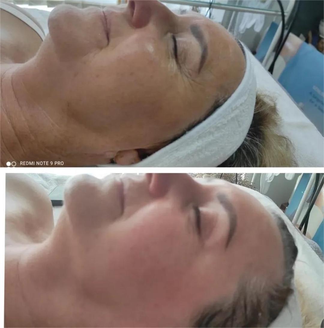 Reviderm mikrodermoabrazija lica + vrata - Delta M, Brčko Tretman lica Lice Tretman lica, Brčko, Centar