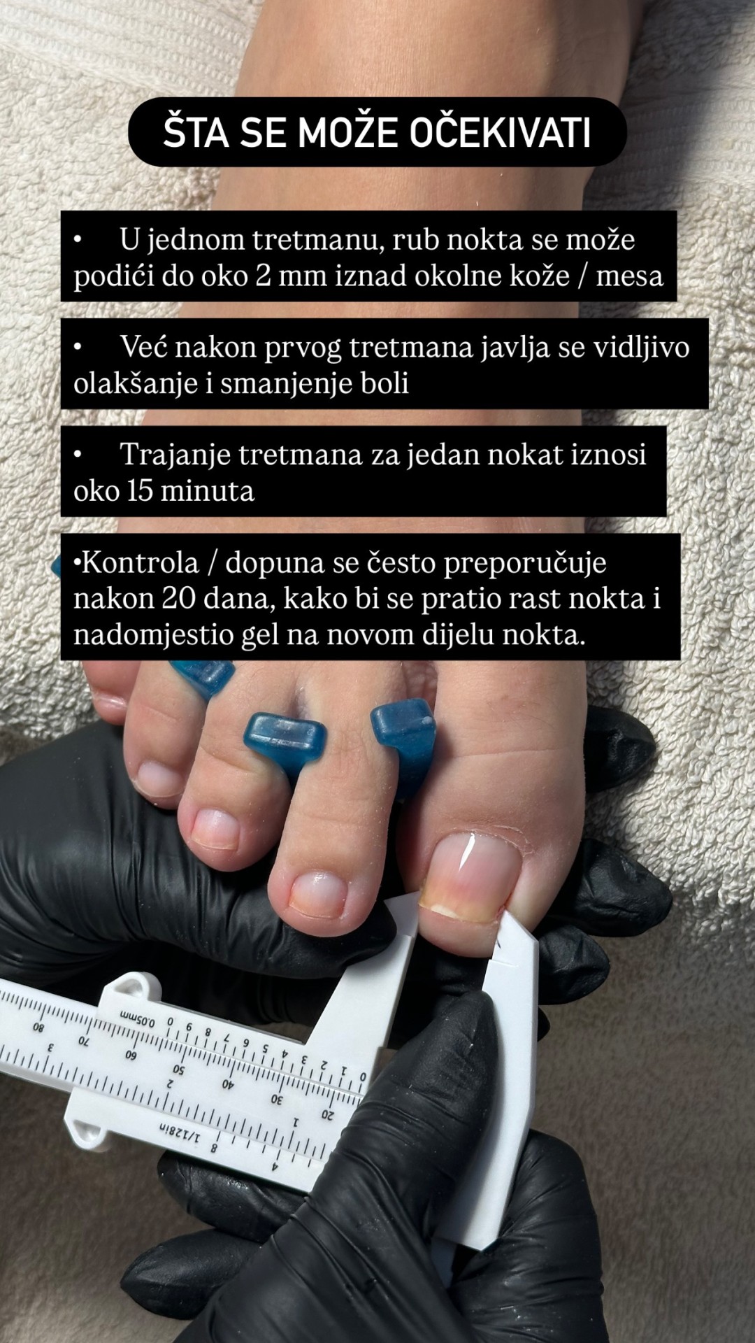 Uljepšaj se #sarajevo Medicinski pedikir Liftup gel - urasli nokat