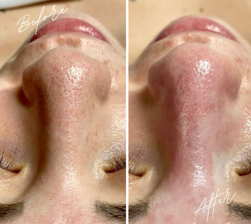 Beauty Studio Señorita #sarajevo Tretman lica Mikrodermoabrazija + Ultrazvučno hranjenje lica