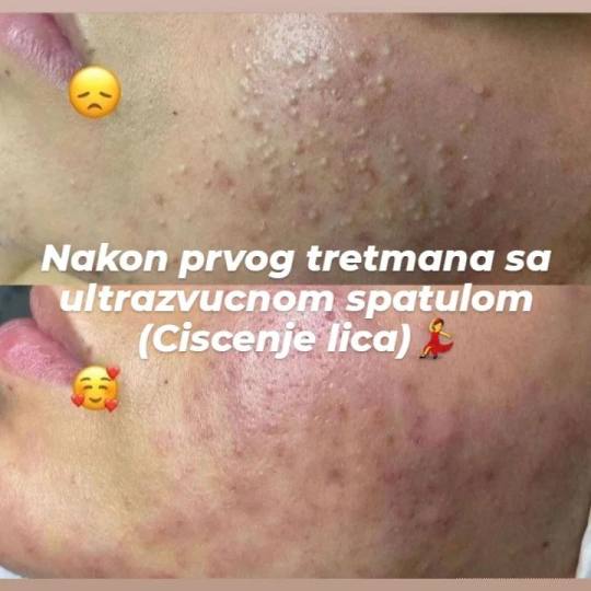 Poezija ljepote #sarajevo Farbanje kose Čišćenje lica + zlatne srebrne niti + maska + masaža Sam