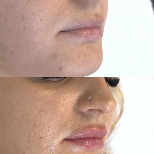Estetika Janković #banjaluka Tretman lica Hijaluronski filer - 1 ml Korekcija usana hijaluronom