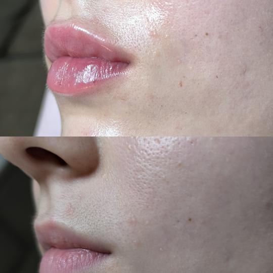 Estetika Janković #banjaluka Tretman lica Hijaluronski filer - 1 ml korekcija usana hijaluronom