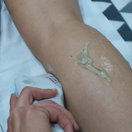 Sandra #visoko Tretmani tijela HiFU - listovi Tretman hi fu laserom koji u prvom tretmanu daje rezul