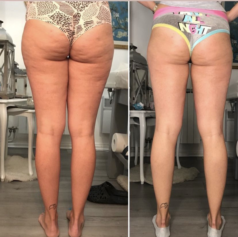 Skockica paket - maderoterapija cijelo tijelo - Fabrika ljepote, Sarajevo Anticelulit masaža Masaža Anticelulit masaža, Sarajevo, Istočno Sarajevo