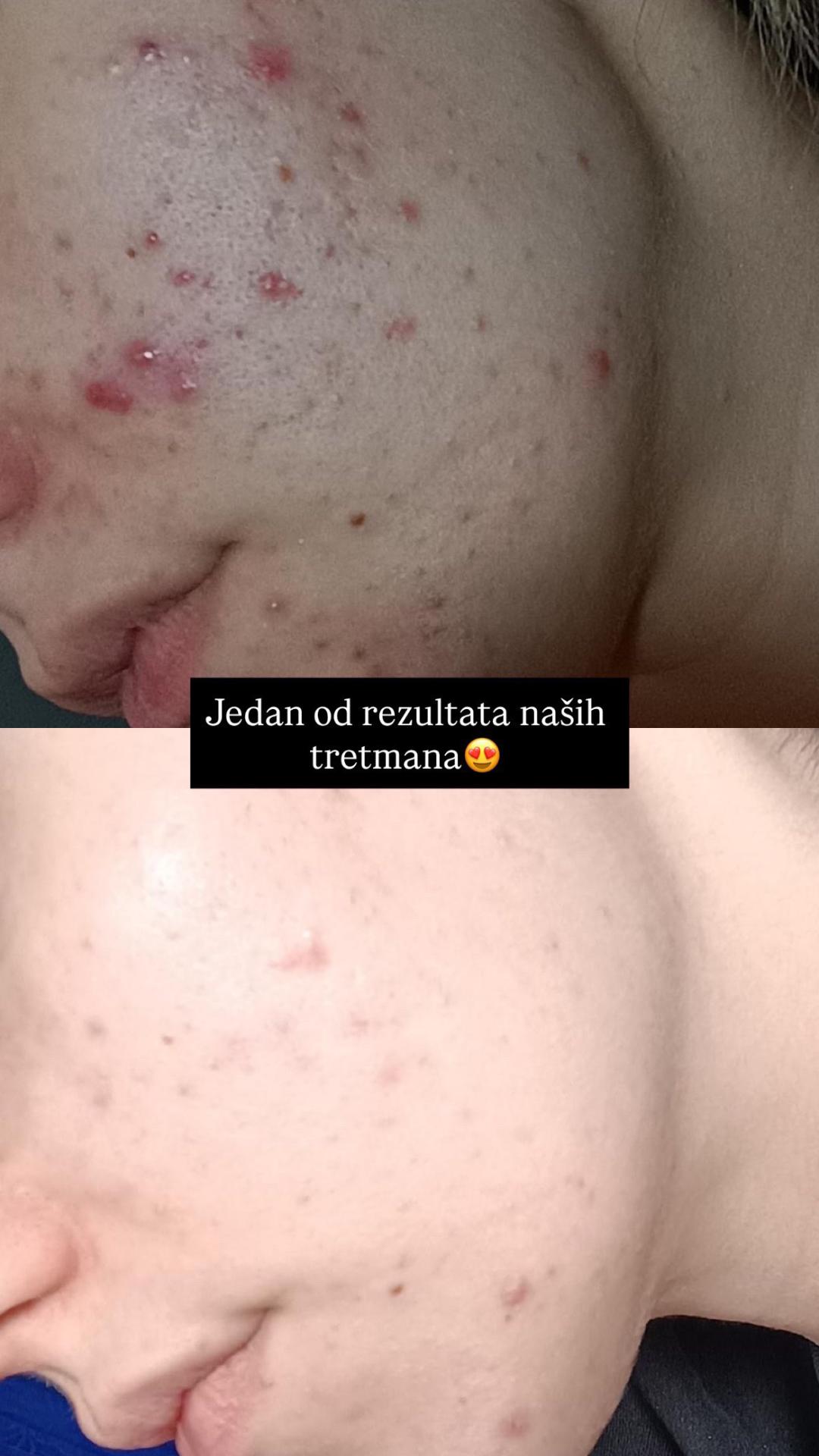 Damen #sarajevo Tretman lica Ultrazvučno čišćenje + microneedling tretman lica