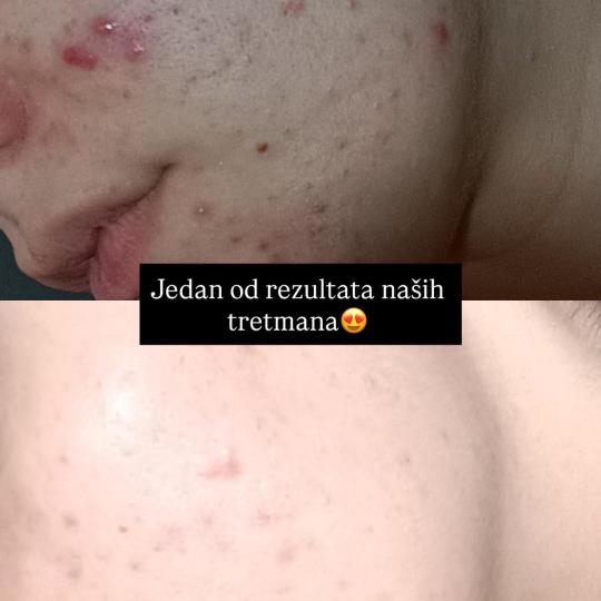 Damen #sarajevo Tretman lica Ultrazvučno čišćenje + microneedling tretman lica Rezultat micronee
