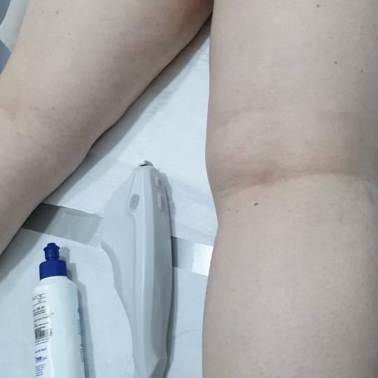 Sandra #visoko Tretmani tijela HiFU - listovi Tretman hi fu laserom koji u prvom tretmanu daje rezul