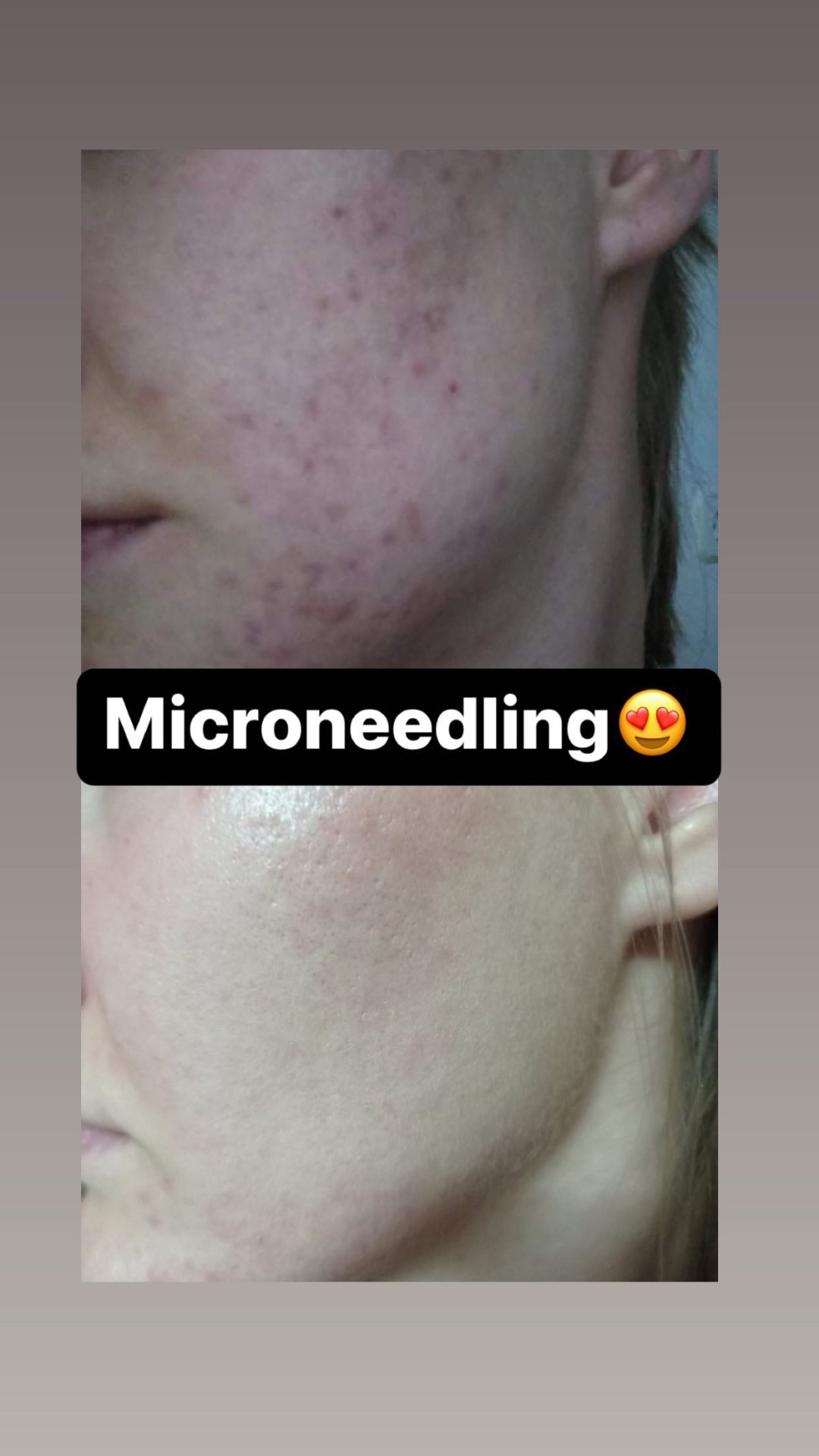 Damen #sarajevo Tretman lica Ultrazvučno čišćenje + microneedling tretman lica