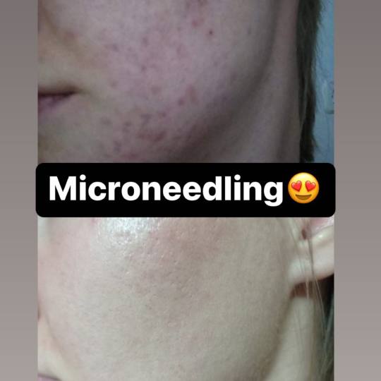 Damen #sarajevo Tretman lica Ultrazvučno čišćenje + microneedling tretman lica Kombinirani tretm