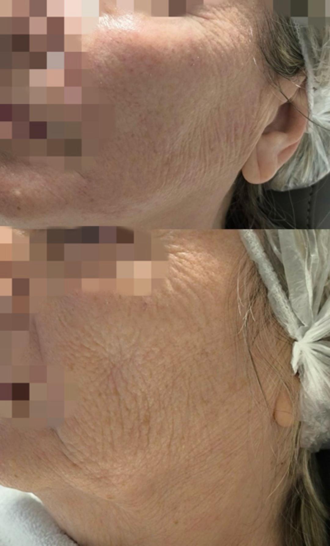 Biorevitalizacija lica -polinukleotidima - Estetika Janković, Banja Luka Tretman lica Lice Tretman lica, Banja Luka, Centar