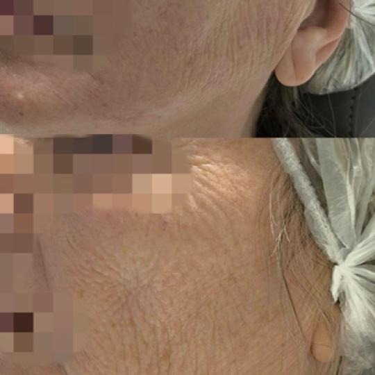 Estetika Janković #banjaluka Tretman lica Biorevitalizacija lica -polinukleotidima Tretman bioregen