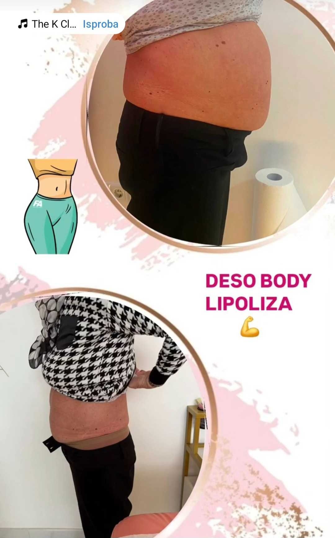 Signature #tuzla Tretmani tijela Lipoliza 10 ml