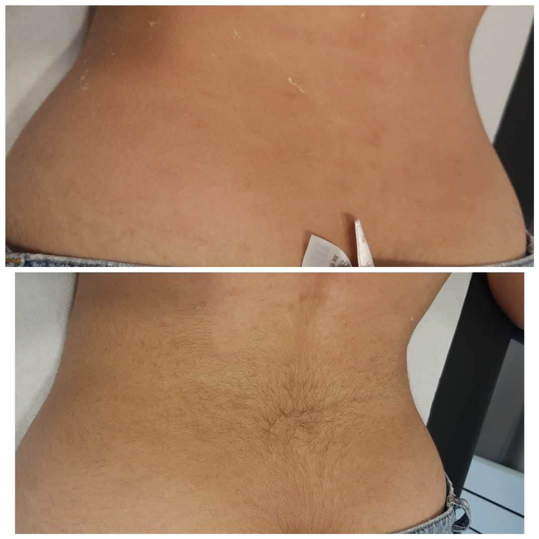 Kuća ljepote Djenna #sarajevo Depilacija šećernom pastom Depilacija leđa šećernom pastom