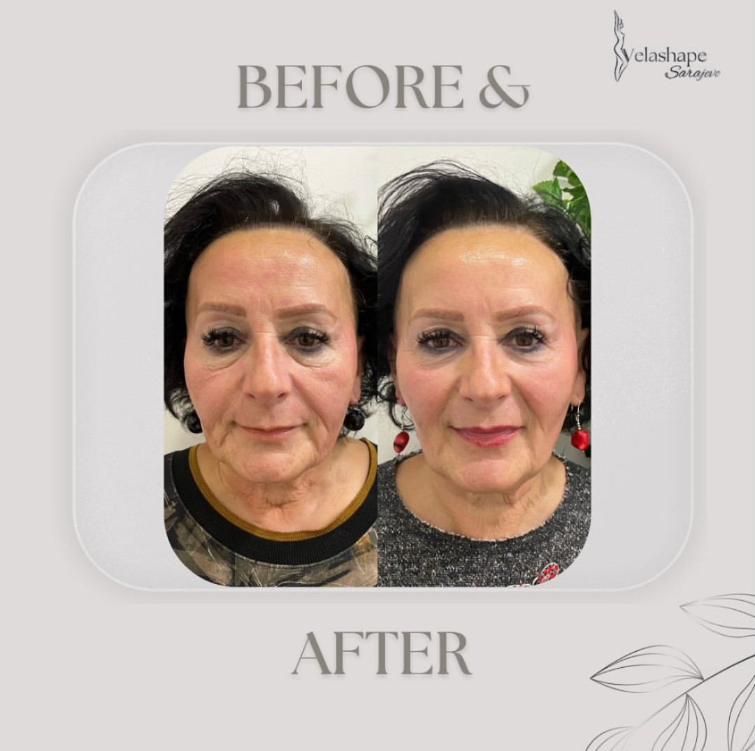 VelaShape #sarajevo Tretman lica RF tretman - lice + vrata