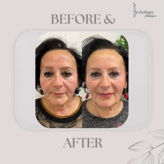 VelaShape #sarajevo Tretman lica RF tretman - lice + vrata Radiofrekvencija lica je neinvazivan tret